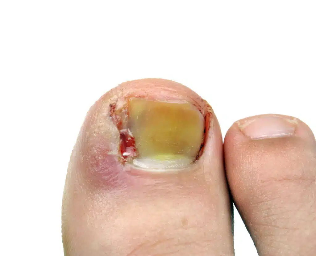 Ingrown toe Nails  Cheltenham Podiatry